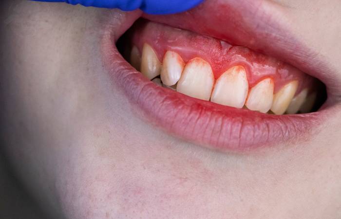 Bleeding gums